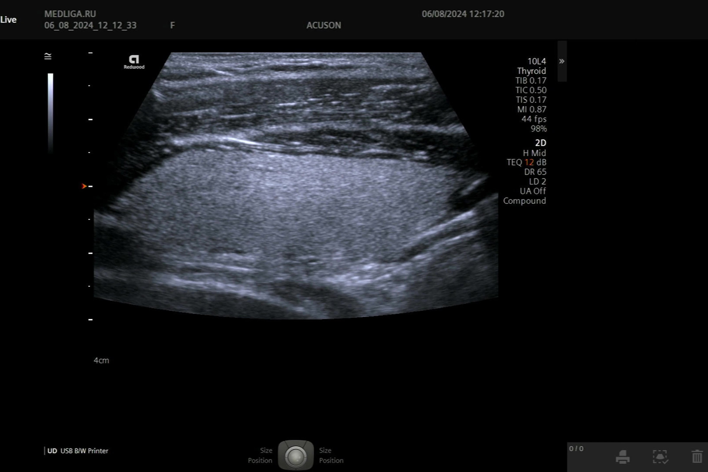 Мастер-класс по УЗИ щитовидной железы на Siemens Acuson Redwood
